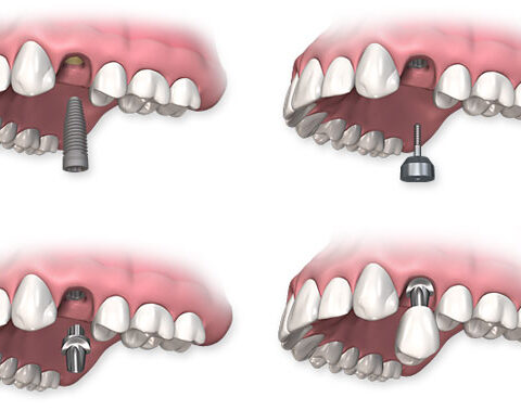 Dental Implants Vancouver Wa