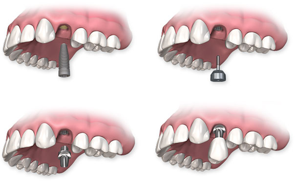 Dental Implants Vancouver Wa